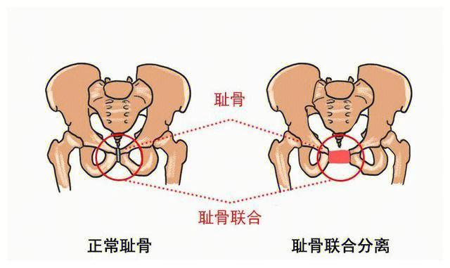 孕四个月耻骨痛，原因、缓解与管理