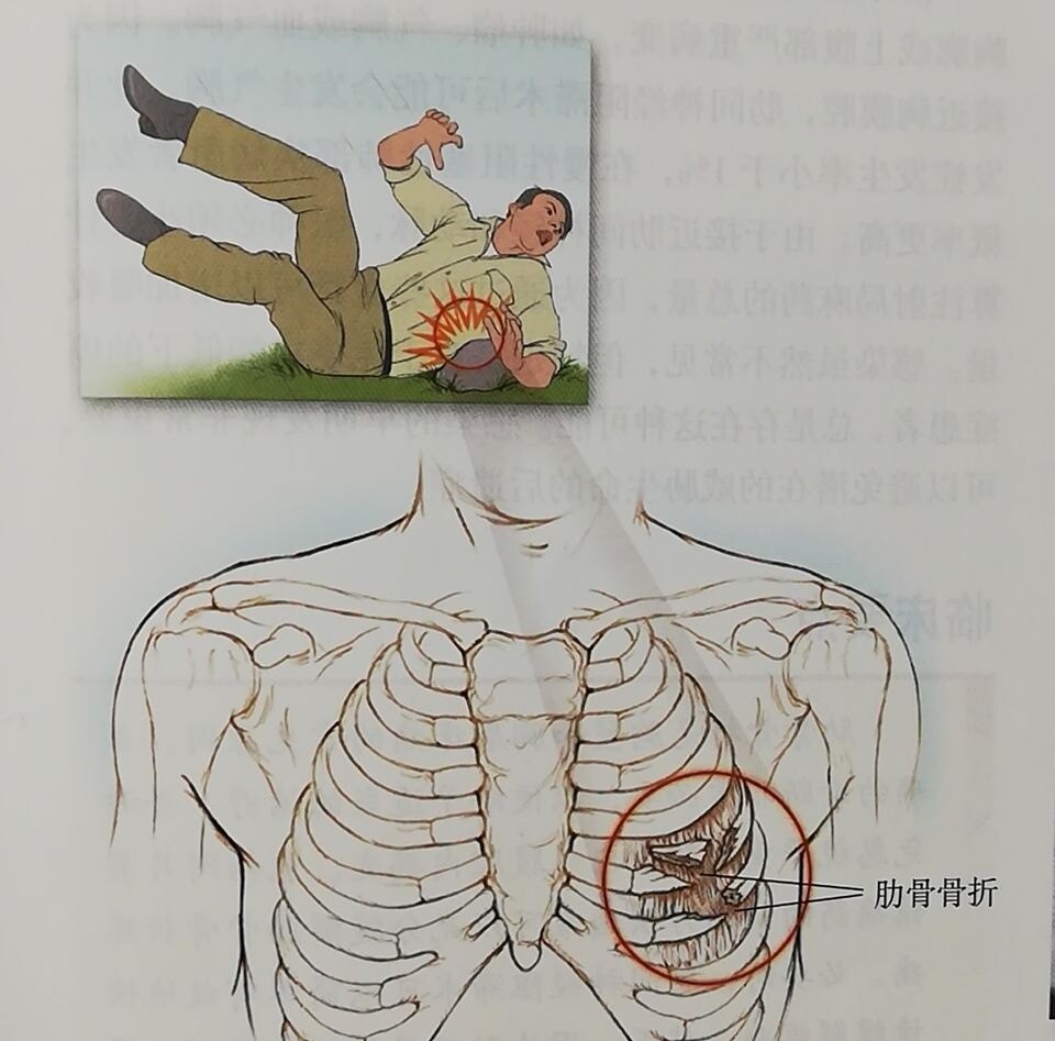 肋骨骨折一个月后的恢复与同房注意事项